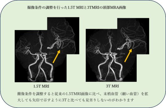 撮影条件調整を行った1.5TMRIと3TMRIの頭部MRA画像