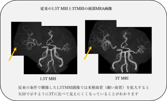 従来の1.5TMRIと3TMRIの頭部MRA画像 